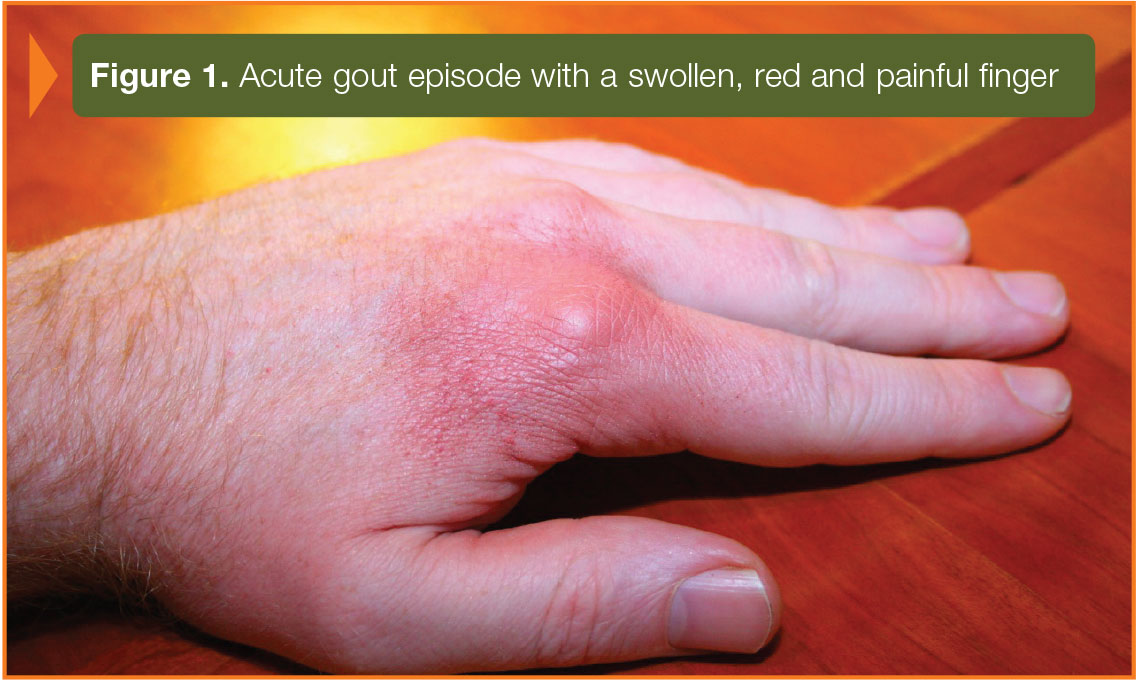 steroid injection for gout