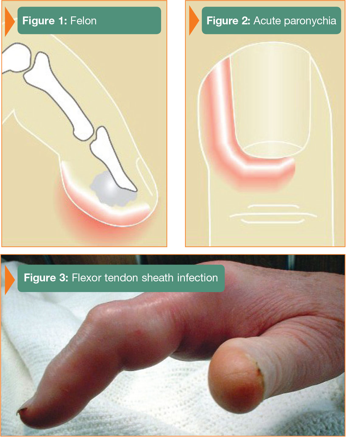 Nails - NAILS Nail functions: -Prevent trauma to distal phalanx  -Counterpressure effect to pulp – - Studocu