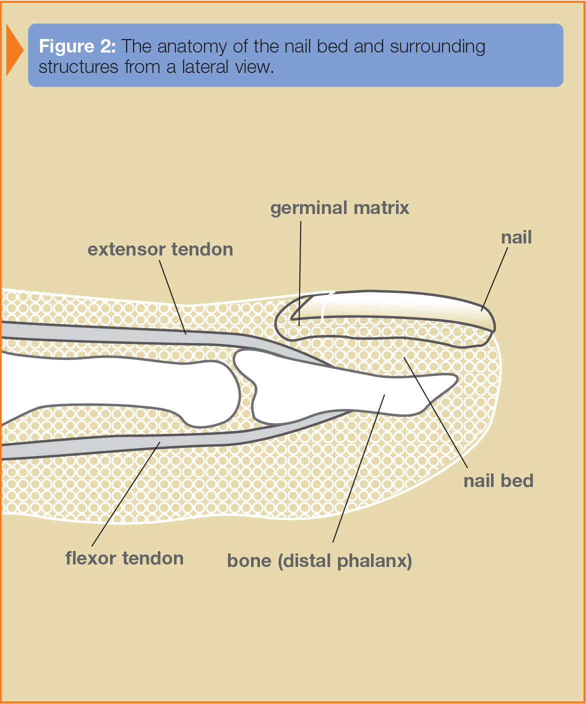 Modified dorsal tension band suture technique for management of finger tip  injuries: A series of 288 fingertip injuries – Trauma International