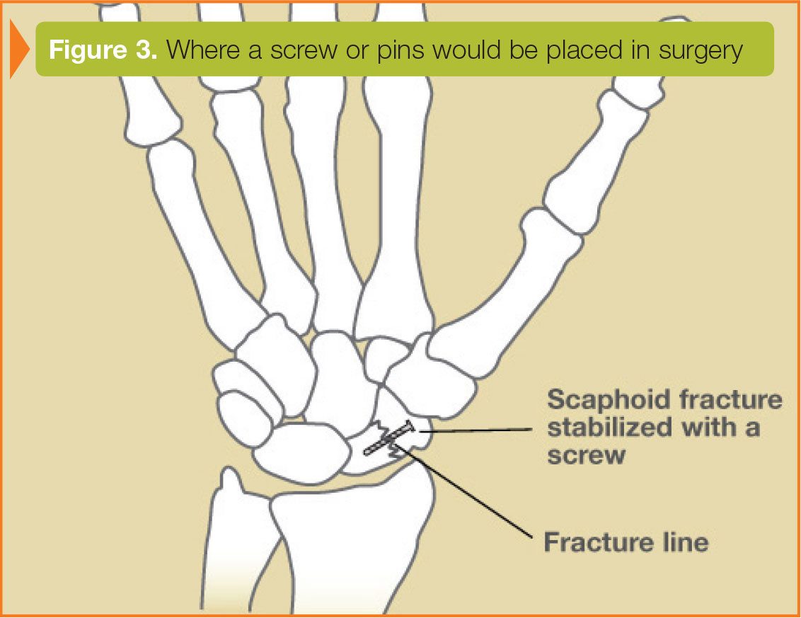 navicular bone fracture